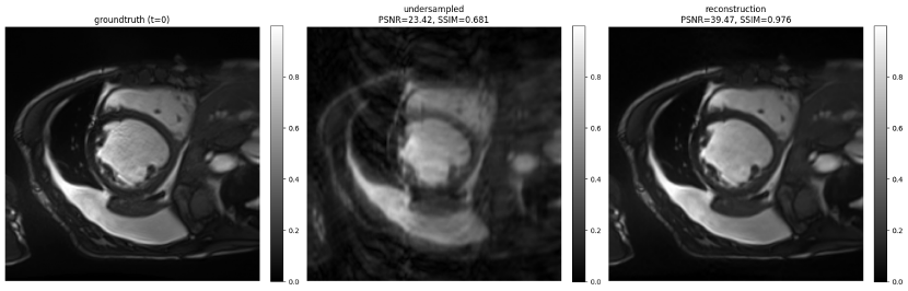 MRI Reconstruction